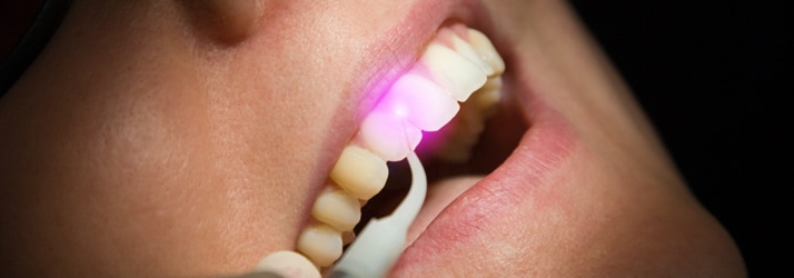 laser gum therapy