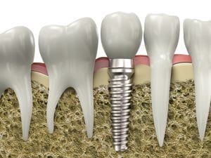 Dentist Chandler AZ Dental Implant