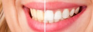 Teeth Whitening in Chandler AZ