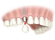 single-dental-implant