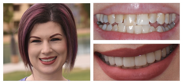 Before and After Dental Care at Mark Arooni DDS