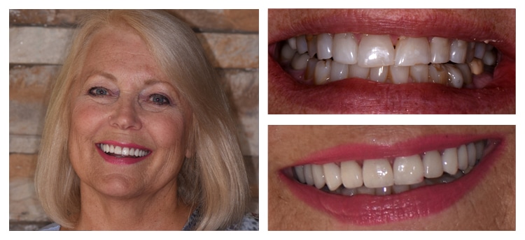 Before and After Dental Care at Mark Arooni DDS