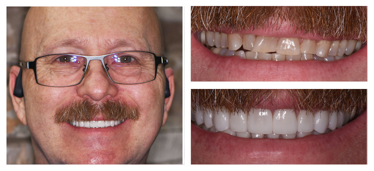 Dentist Chandler AZ Before and After David