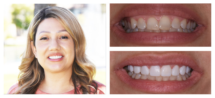 Dentist Chandler AZ Before and After Grace
