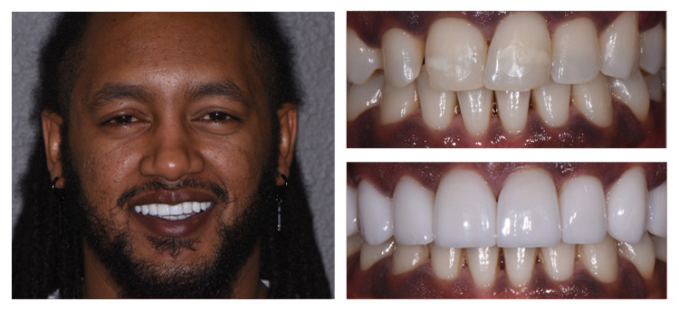 Dentist Chandler AZ Before and After Kassa