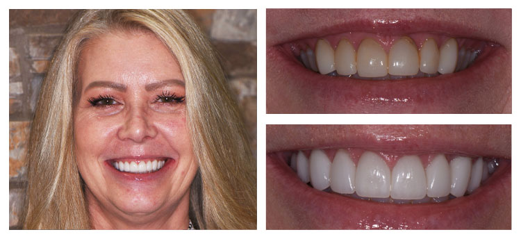 Dentist Chandler AZ Before and After Nanette Berner