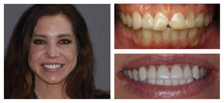 Dentist Chandler AZ Before and After Sarah