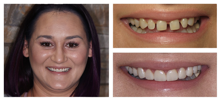 Dentist Chandler AZ Before and After Smile Gallery